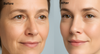 Botox Treatment for wrinkles