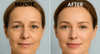 Dermal FIller in Florida