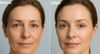 Microneedling Before And after.png